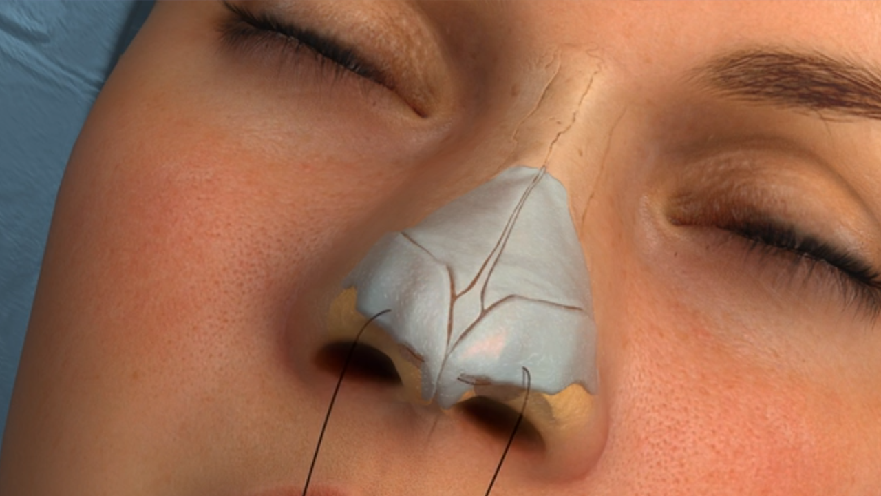 Nose job: The Complete Guide to Surgery and Recovery